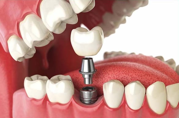Monarchy married multipurpose Pivotul dentar – ce este și când se recomandă