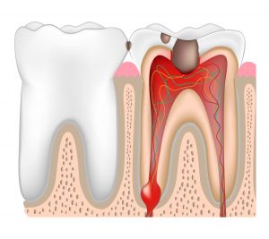pulpa dentara inflamata